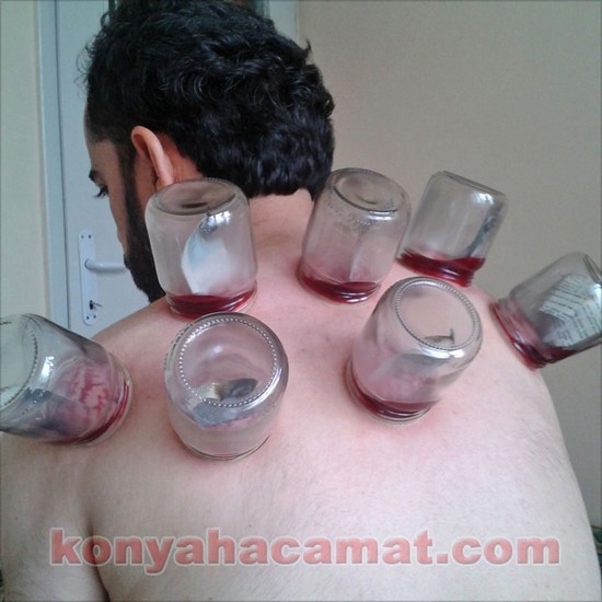 KESKİNOĞLU; Cupping therapy,hicame,leech therapy,manual therapy,Cupping therapy training and education